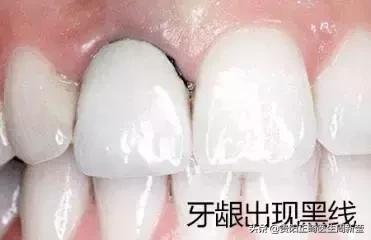 烤瓷牙做过后最好的修复方法,烤瓷牙里面的真牙烂了怎么办