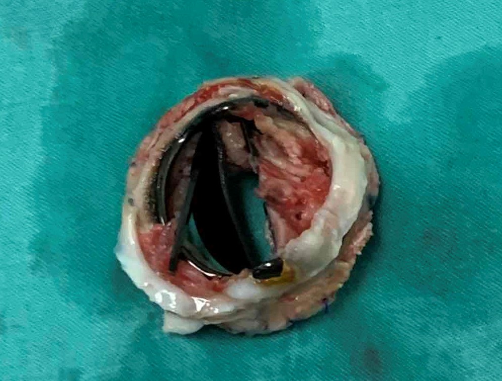 中国首例经导管主动脉瓣置换术,微创瓣膜置换手术预期效果