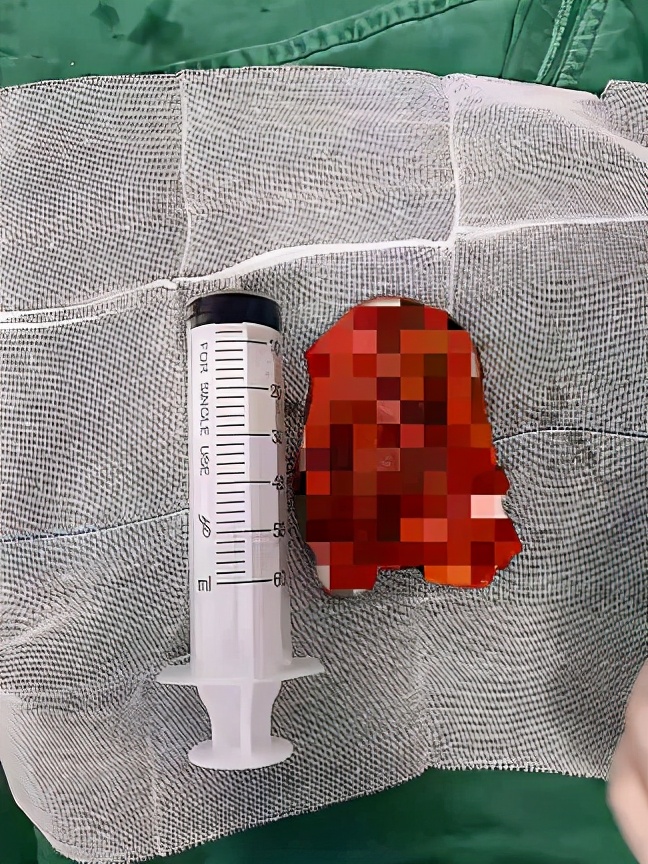 如何判断自己是不是满月脸水牛背,满月脸水牛背是什么原因引起的