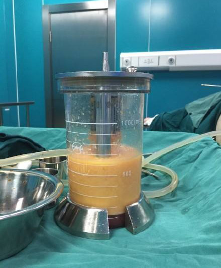 怎么才能让萝卜腿变成细腿,小腿萝卜腿的矫正方法