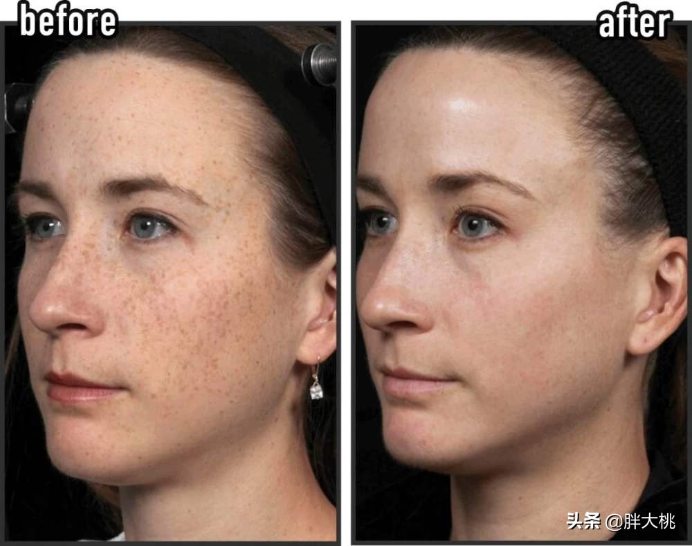 皮肤长黑头闭口刷酸真的可以吗,黑头刷酸有用吗能收缩毛孔吗