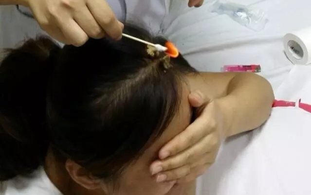 周楣声灸法理论,周楣声谈吹灸