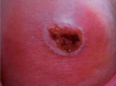 蒲地蓝消炎口服液是治什么的药,蒲地蓝消炎口服液小孩能喝吗