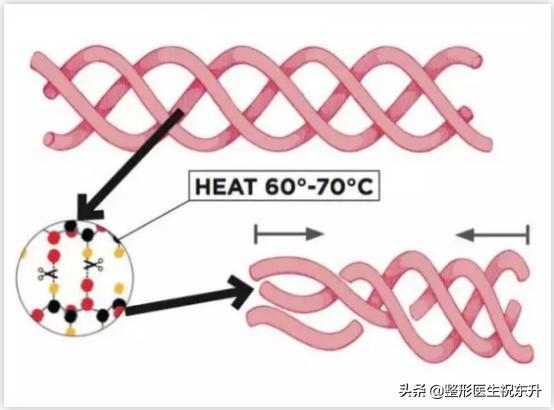 超声炮做了之后脸部有凹陷怎么办,超声炮刚做完脸部凹陷是怎么回事