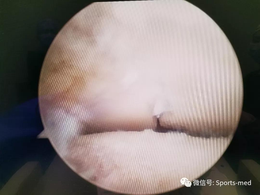 距骨软骨损伤的关节镜治疗,距骨软骨损伤关节镜手术