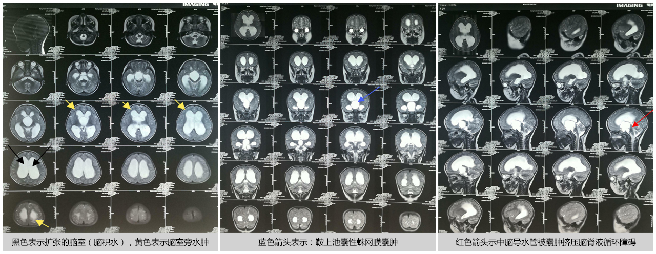 鞍上池蛛网膜囊肿会引起脑积水吗,枕大池蛛网膜囊肿属于脑积水吗