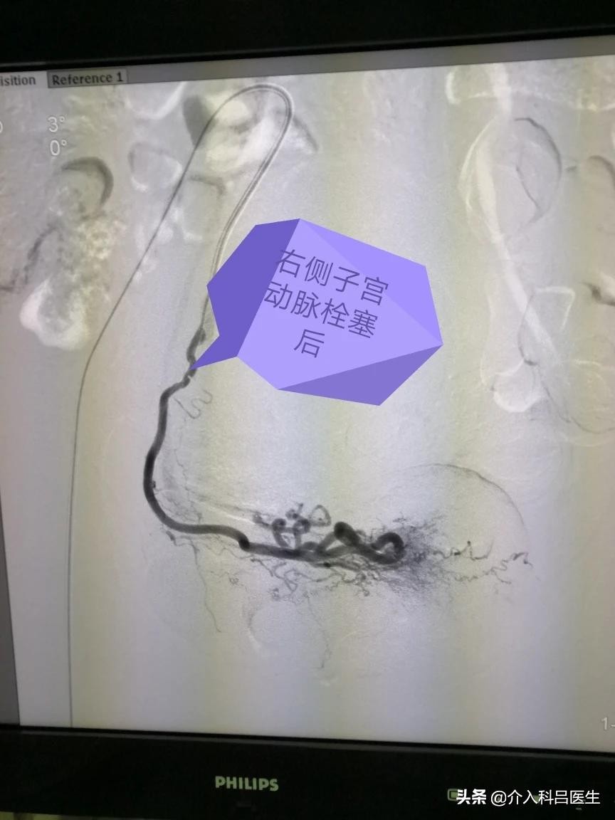 子宫肌瘤囊肿50岁手术风险,子宫肌瘤长在前壁42x32mm需要手术