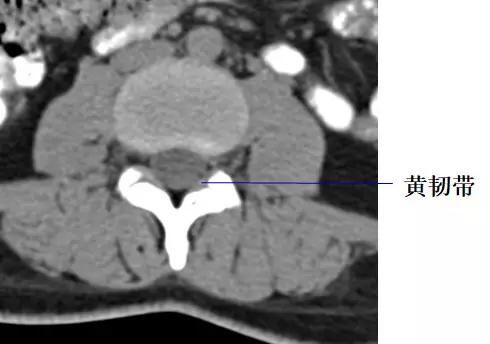 颈椎腰椎疾病ct及mri诊断,腰椎ct可以发现肠部病变吗