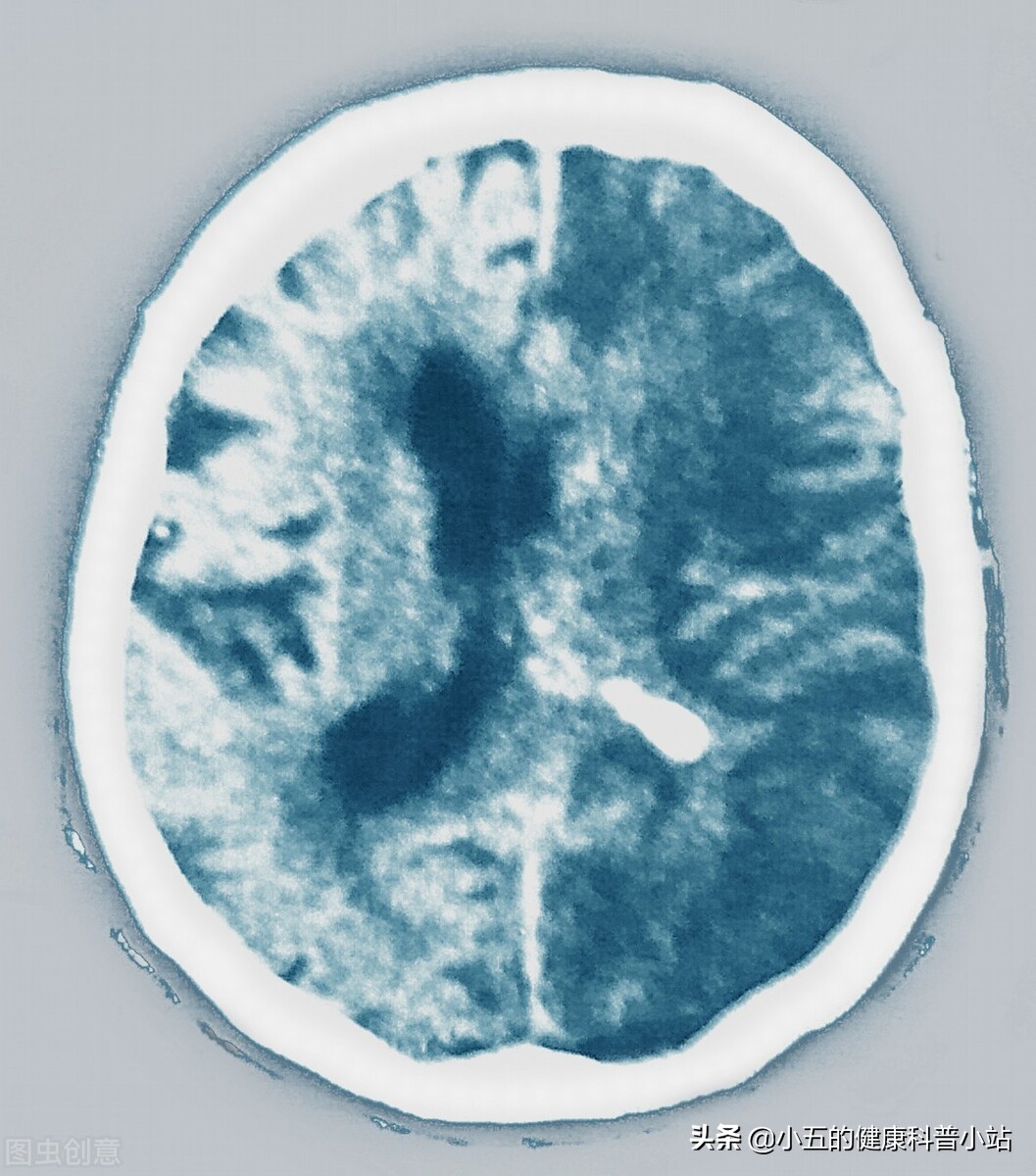 心房颤动注意事项有哪些,引起心房颤动的诱因