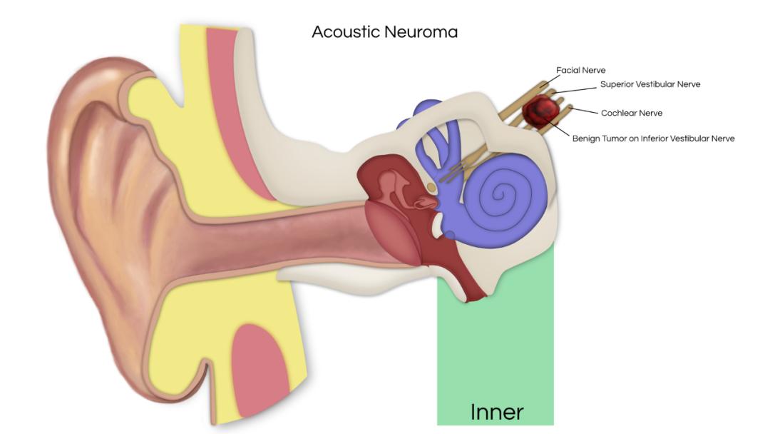 听神经瘤复发做二次手术,听神经瘤复发能要命吗