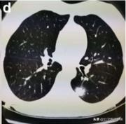 新型冠状病毒感染的肺炎患者肺部影像学改变