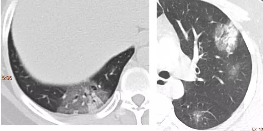 新型冠状病毒肺炎相关知识答疑,新型冠状病毒肺炎必须知道什么