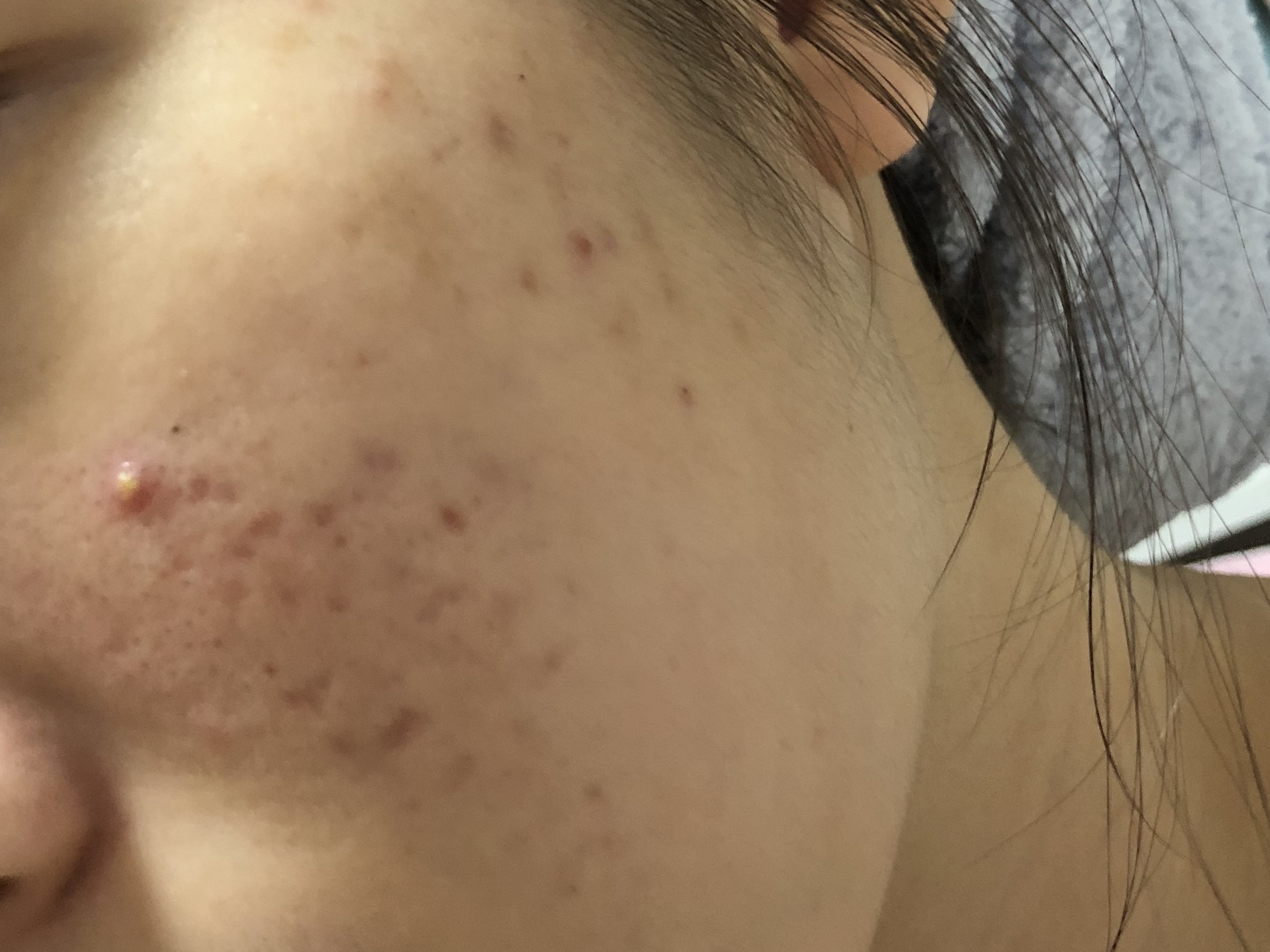 17岁女儿脸上长满痘痘，看了这篇文章才知道如何帮助她