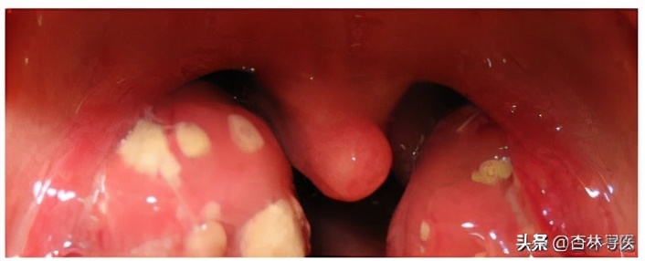 儿童嗓子发炎化脓快速解决方法,孩子喉咙发炎化脓怎么治疗最快