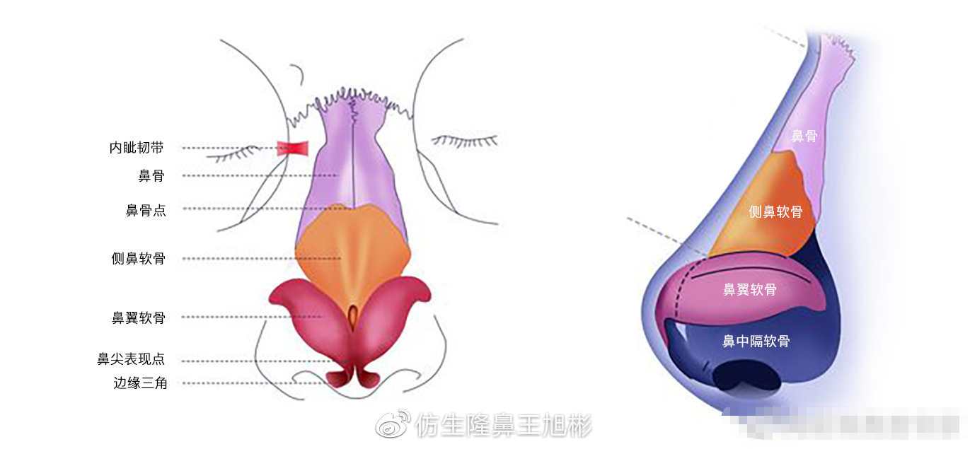 假体隆鼻耳软骨垫鼻尖图片,l型假体耳软骨隆鼻图片