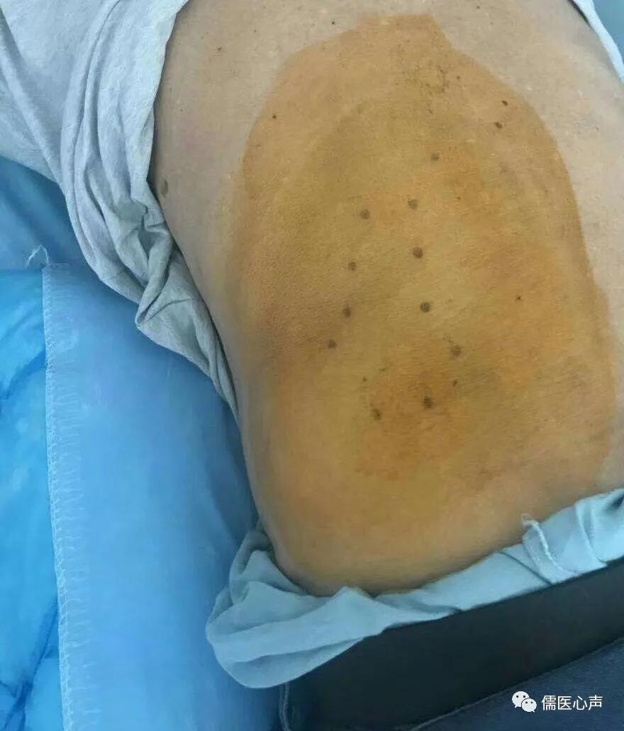 腰部往里凹了经常疼,腰部往上一点脊柱两侧疼痛的原因