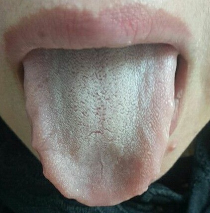 肾虚和湿气有关系吗,肾虚与湿热有关系吗