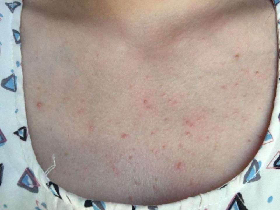 后背长了很多小米粒,后背长满小米粒的原因