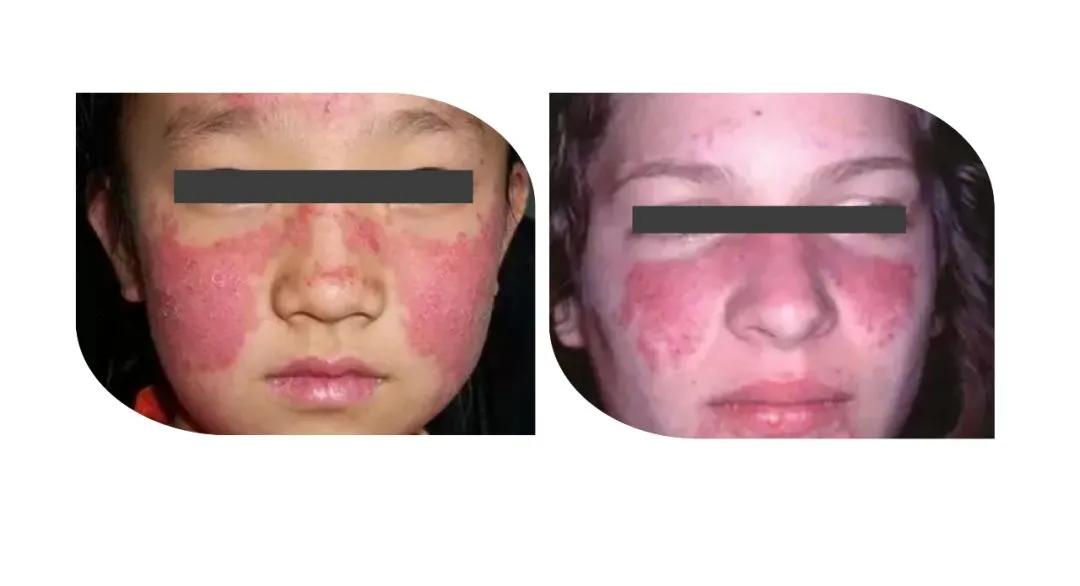 系统性红斑狼疮新药研发首批上市,系统性红斑狼疮治疗新药新进展