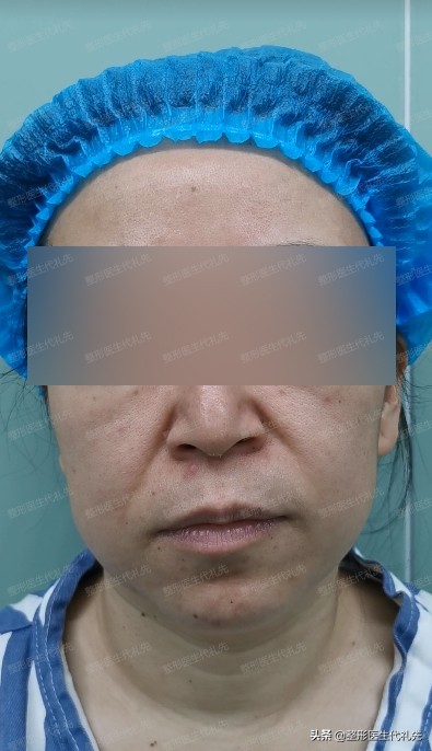 皮肤松弛下垂做什么医美最有效,皮肤下垂松弛做什么美容好