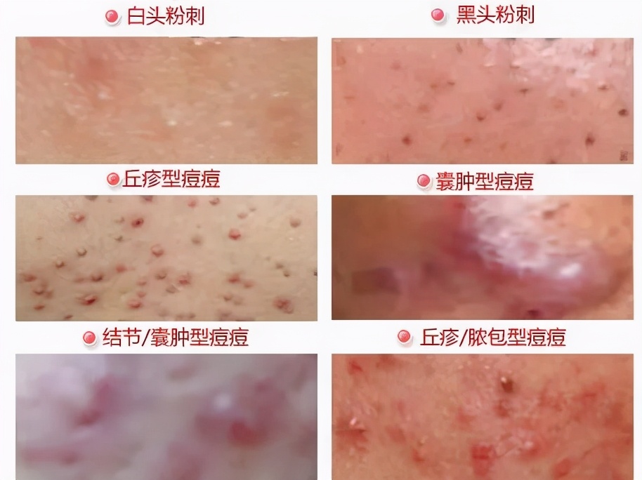 痘痘破了擦阿达帕林行吗,痘痘克星软膏