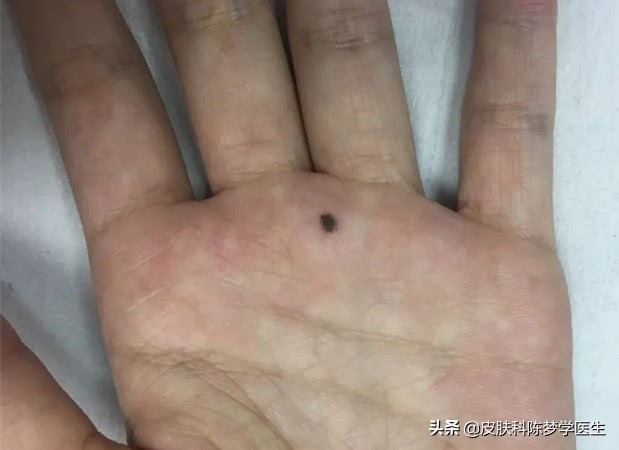 脸上长很多痣是好还是坏,脸上痣发炎红肿是癌变吗