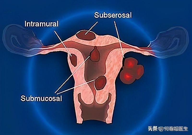 子宫肌瘤如何选择手术方式,肌壁间子宫肌瘤压迫内膜手术方式
