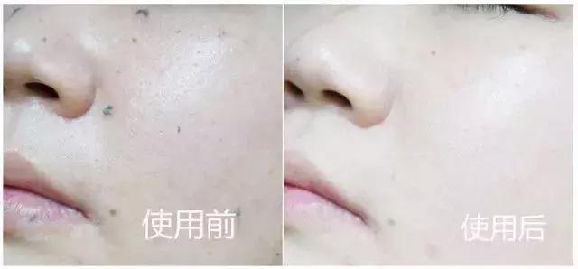 洗脸清洗黑头,洗脸清洁去粉刺