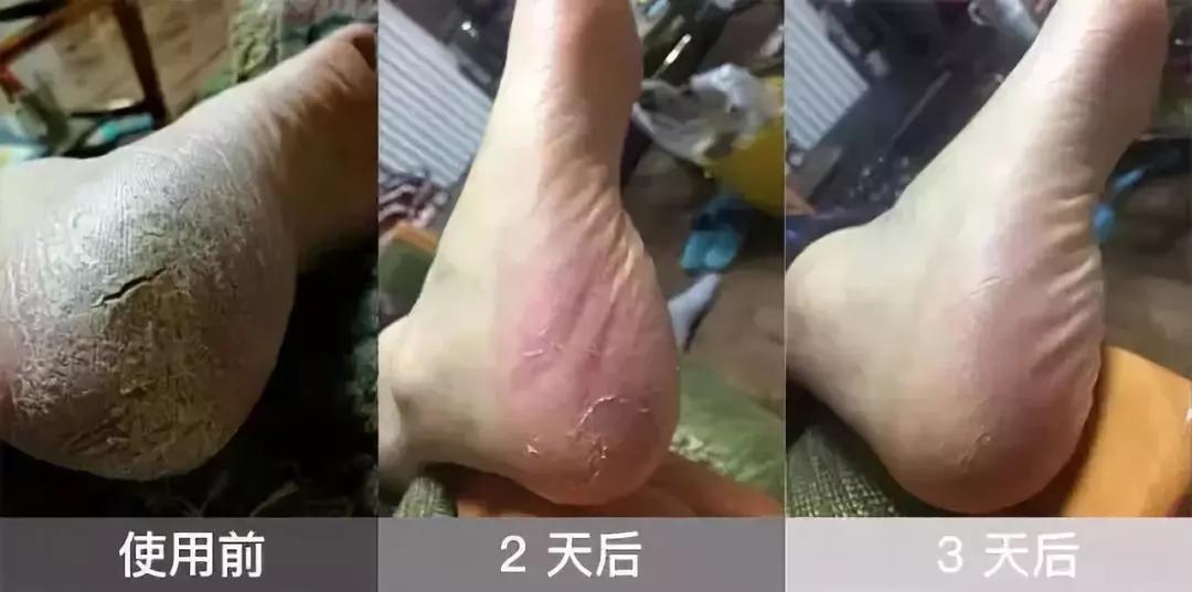 加拿大皲裂霜,加拿大修复膏