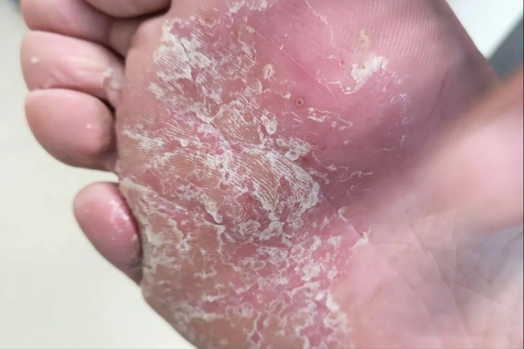 脚上干裂居然是真菌惹的祸