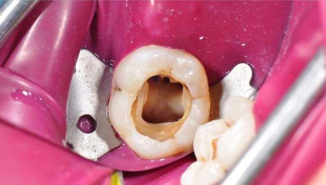 牙齿残根拔掉有什么危害吗,牙齿残根残冠要不要拔掉