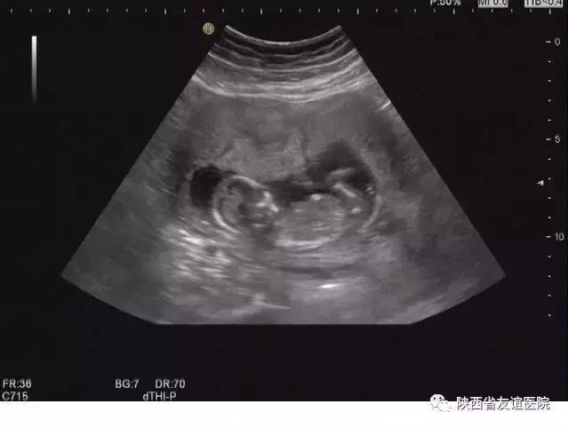 孕妇超声检查的几大误区,孕妇12周超声检查图片怎样看