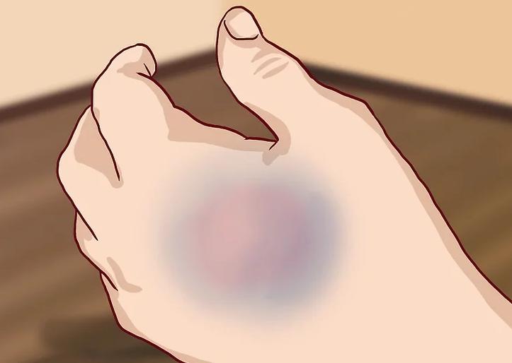 手骨折反复疼痛怎么办,手痛了一个月是骨折吗