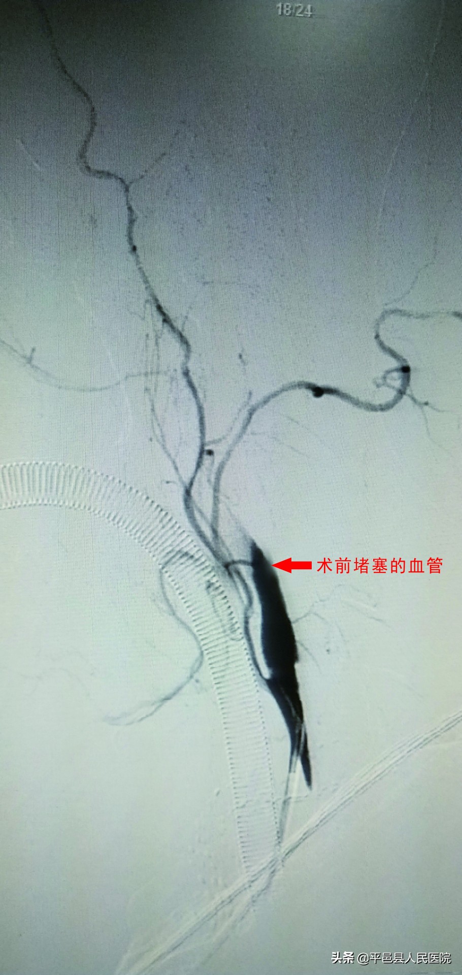 【特色诊疗】平邑人身边放心的“国家级示范防治卒中中心”不负百姓健康重托