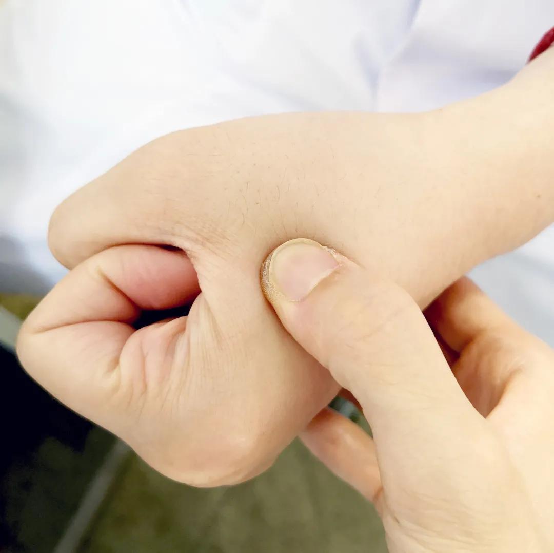 儿童过敏性鼻炎的治疗方法推拿,过敏性鼻炎咳嗽推拿哪些穴位