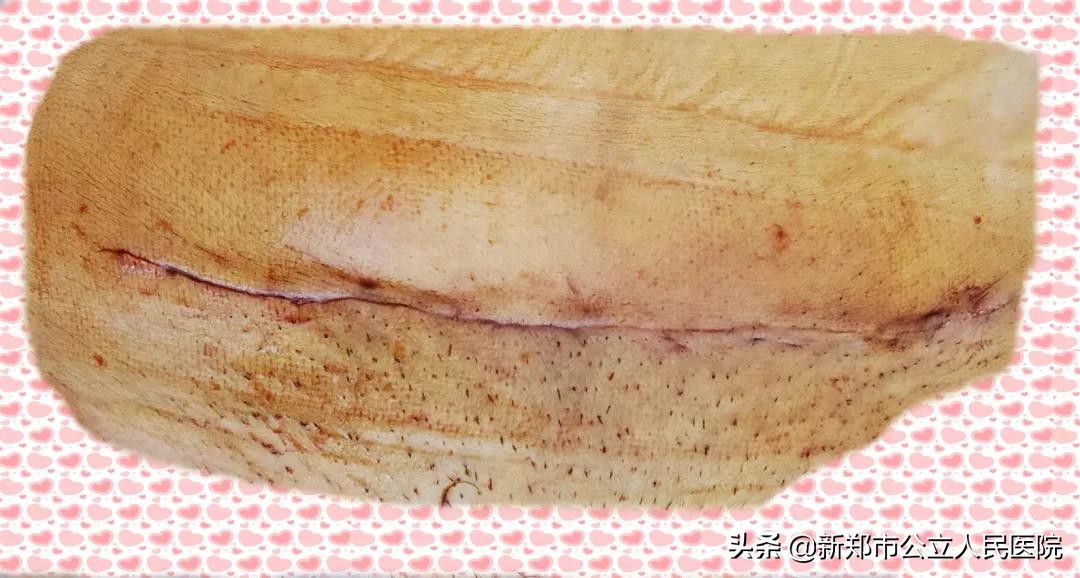 剖腹产双眼皮,剖腹产抬屁股避免压肚子