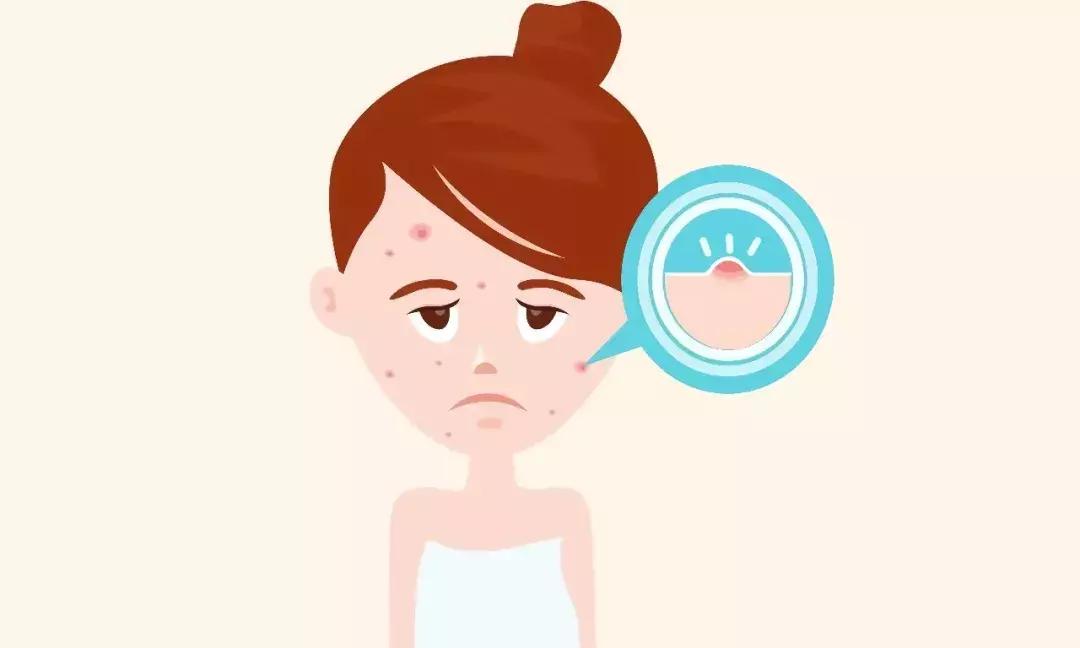 手把手教你正确挤痘不留坑,挤痘有个坑怎么补救