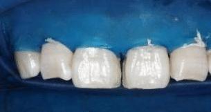 门牙裂了一条缝,门牙有缝的女人