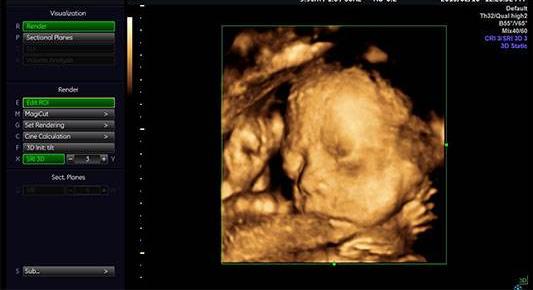 四维彩超大揭秘：怀孕了，你做四维彩超检查了吗？