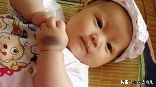 新生儿宝宝胎记,新生儿宝宝脸上的胎记能治吗