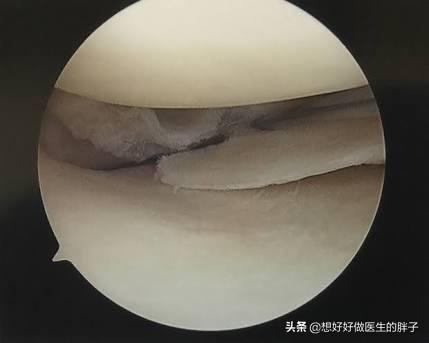 走路膝盖会突然软一下就骨折,走路时膝盖突然软一下怎么治