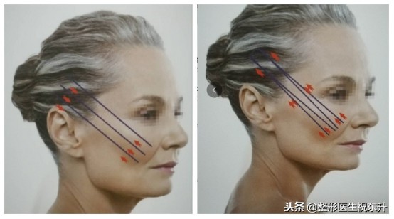 年龄大了想祛法令纹又不想动刀,泪沟法令纹不用动刀就能掩盖掉