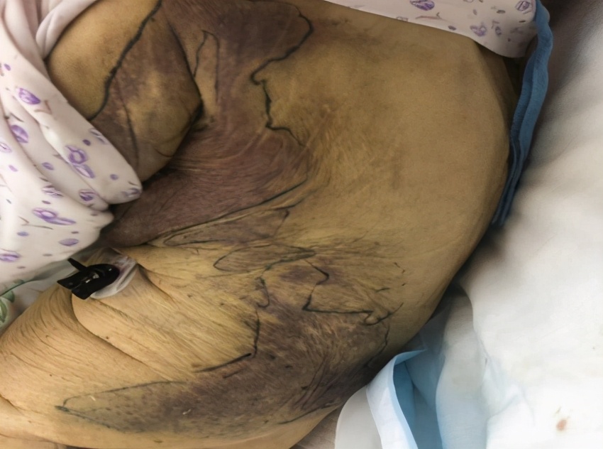 弥漫性血管内凝血属于重大疾病吗,弥漫性血管内凝血最常见的原因是