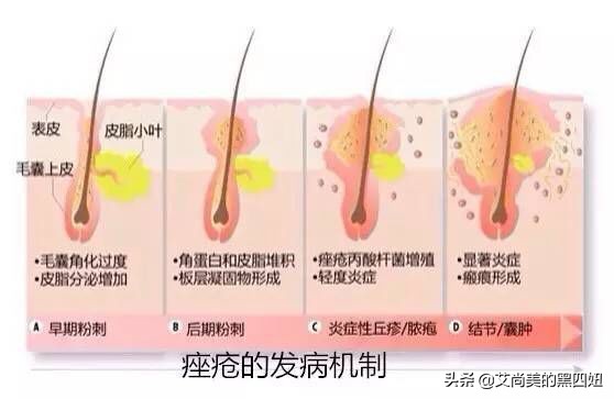 别再为痘痘烦恼祛痘小窍门送给你,长痘了这些护理方法你得知道