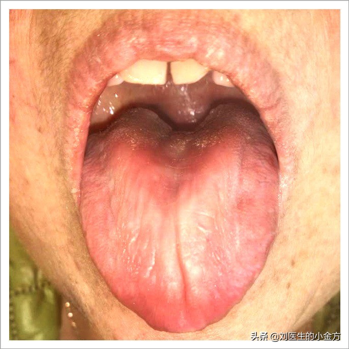 舌象图解大全中医舌诊,最全中医舌诊图谱来了
