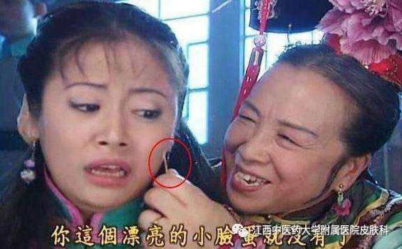 黄金微针去痘印前后对比,第四代黄金微针治痘坑