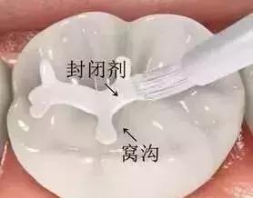 小孩少一颗牙最好的补救方法,孩子的牙有问题趁早看