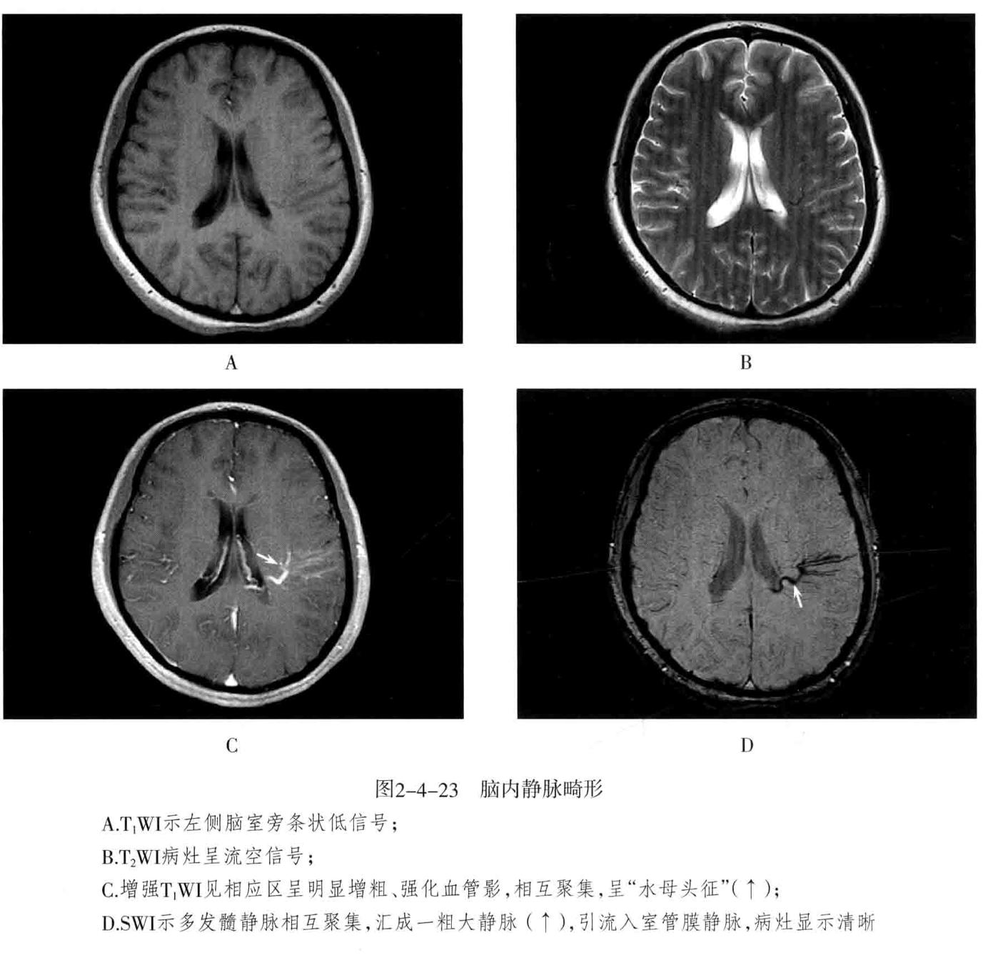 颅内血管轻度狭窄诊断标准,颅内血管先天变异影像