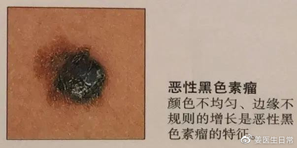 想把脸上的痣去掉去医院哪个科,脸上危险三角区的痣可以去掉吗