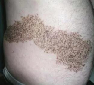 雀斑样痣是雀斑的一种吗,雀斑痣和健康痣有什么区别